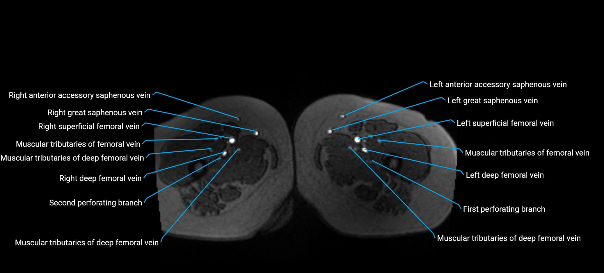 MRV abdomen pelvis & lower limb axial cross sectional anatomy labelled MRI image 227 (1).webp